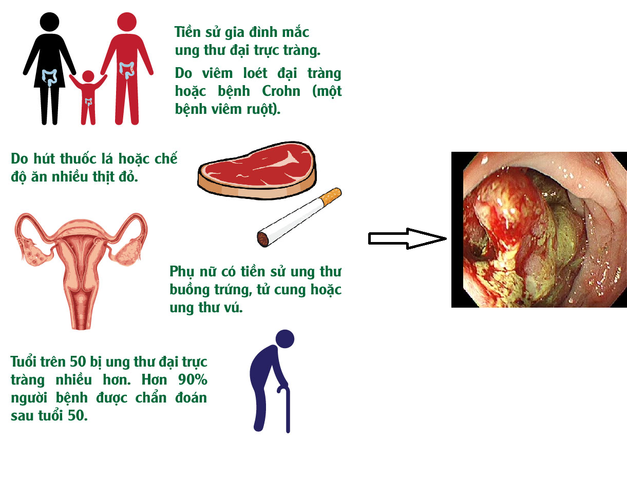 Bật mí cách điều trị ung thư trực tràng bằng nấm lim xanh 2