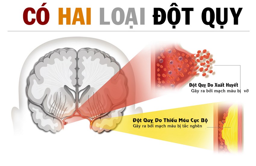 Người bệnh tai biến mạch máu não có uống Nấm Linh Chi được không ? 1