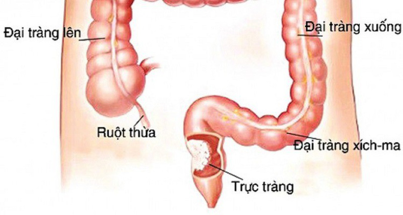 Bật mí cách điều trị ung thư trực tràng bằng nấm lim xanh 1