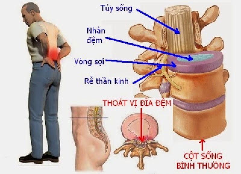 Nấm linh chi hỗ trợ điều trị bệnh thoát vị đĩa đệm 1